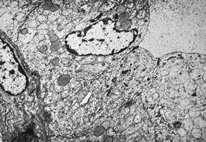 F, 73y. | follicular carcinoma of thyroid gland F, 73y. | follicular carcinoma of thyroid gland